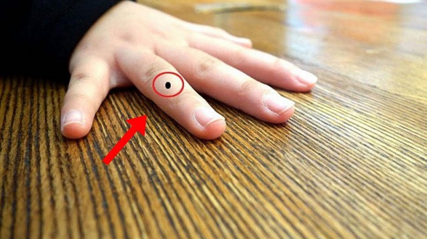 Có nên tẩy nốt ruồi không?