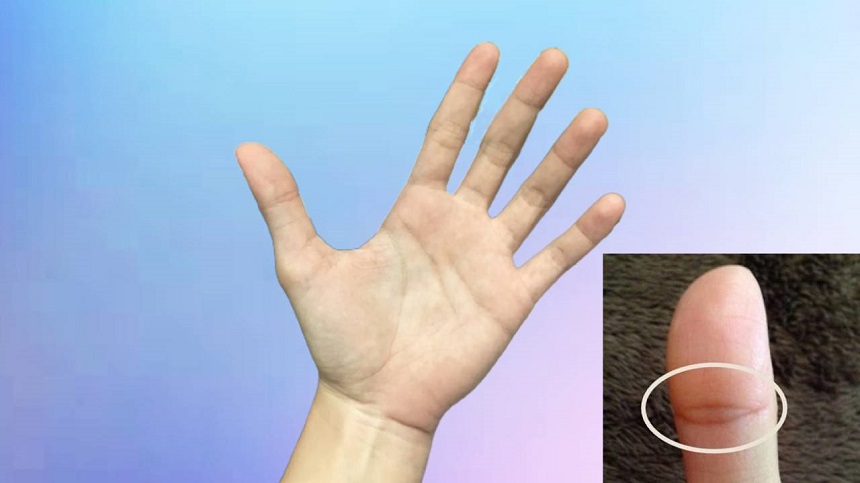 Nốt ruồi ngón tay cái